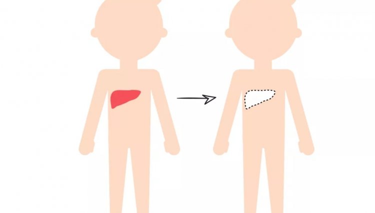Transplante de fígado representa um dos maiores progressos da medicina